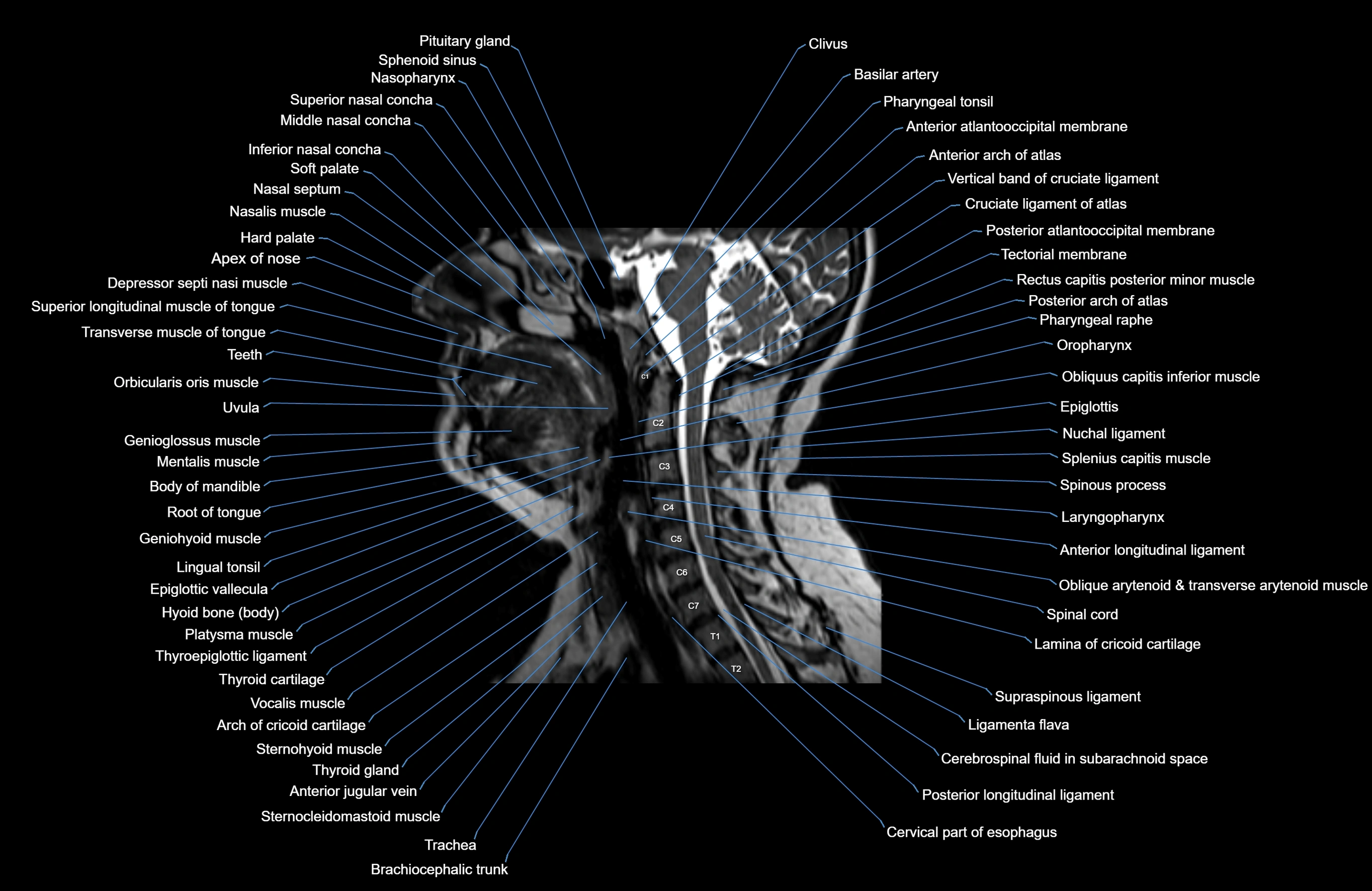 Neck MRI sagittal cross sectional anatomy 3D 1mm 3T radiology  image-img-00001-00004.webp